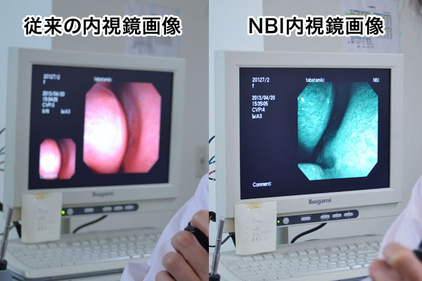 鼻咽頭・喉頭内視鏡検査　NBI検査