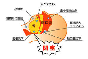 閉塞性睡眠時無呼吸(OSA)のイラスト解説図